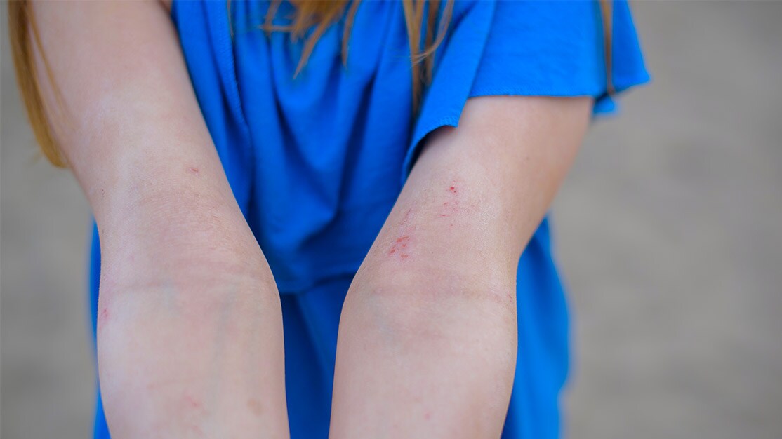 What is Contact Dermatitis?